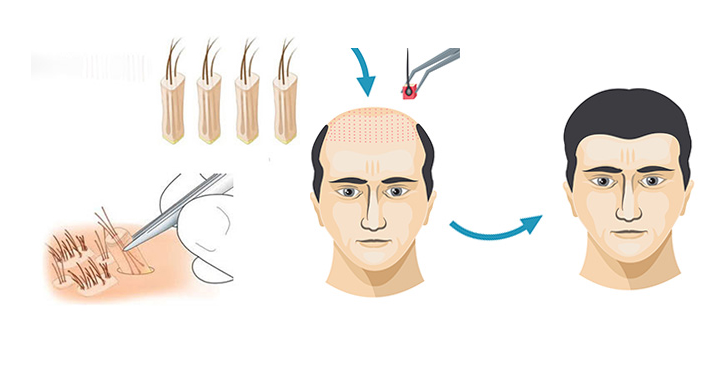 Tìm hiểu cách trị hói đầu bằng phương pháp cấy tóc tự thân