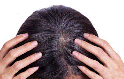 Vì sao tóc bạc ở đỉnh đầu? Biện pháp nào giúp khắc phục hiệu quả tình trạng này?